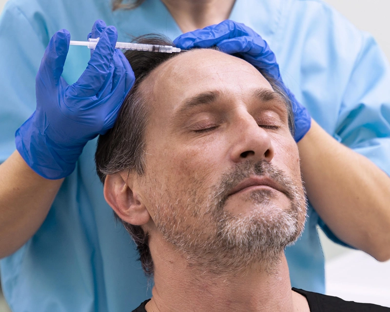 hair-transplant-before-after-results-vcare